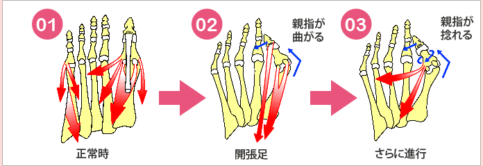 外反母趾の原因！ハイヒールは勘違いって本当？！