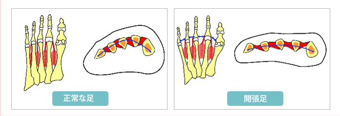 外反母趾の原因、開張足が引き起こるワケ